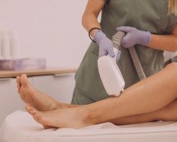 Laser hair removal