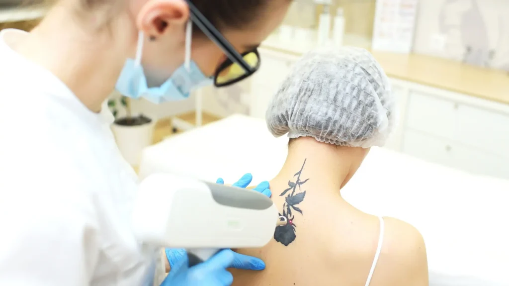 Tattoo removal: Waarom kiezen voor laserbehandeling?