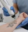 Close up van tattoo verwijdering met picosecondelaser op onderarm, zonder zichtbare tekst