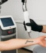 Laser verwijdert tatoeage met naam op onderarm in een steriele kliniek, geen overige zichtbare tekst