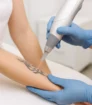 Tattoo weglaseren met picosecondelaser op onderarm, klinische omgeving, zonder zichtbare tekst