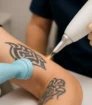 Laserbehandeling voor het verwijderen van een tatoeage op de onderarm in een klinische setting