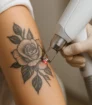Laserbehandeling voor het verwijderen van een tatoeage op de bovenarm