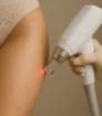 Laserontharing bovenbeen door specialist met medische precisielaser