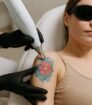 Een medische professional verwijdert een kleurrijke tatoeage met een picoway laser.