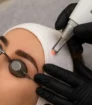 Close up van een vrouw die een laserbehandeling ondergaat voor het verwijderen van permanente make-up op de wenkbrauwen, met beschermende oogkapjes en een steriele setting.