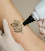 Laserbehandeling van een bloemvormige tatoeage op de bovenarm