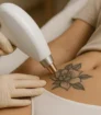 Tattoo verwijdering met laser op de bovenarm uitgevoerd door een specialist.