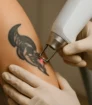 Close-up van laserbehandeling bij tatoeage op bovenarm