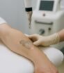 Laserbehandeling op onderarm tijdens tattoo verwijdering met moderne apparatuur.