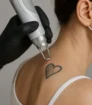 Een close-up van een professionele huidbehandeling waarbij een picoseconde-laser wordt gebruikt om een tatoeage op de onderarm te verwijderen. Geen zichtbare tekst, medisch hygiënische setting.