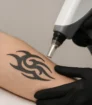 Tattoo verwijdering met laser op een onderarm, zonder zichtbare tekst