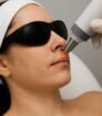 Vrouw ondergaat laserontharing in het gezicht met beschermende bril