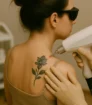 Laserbehandeling voor tatoeageverwijdering op de schouder van een vrouw met een bloemontwerp.