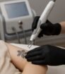 Close-up van een Picoway laserbehandeling voor het verwijderen van een zwarte tribal tattoo op de bovenarm