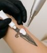 tatoeage verwijderen voor het verwijderen van een zwarte tribal tatoeage met verdovende crème
