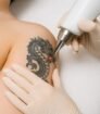 Laser verwijdert oudere drakentattoo op bovenarm; rode laservonk zichtbaar tijdens professionele behandeling