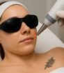 Vrouw ondergaat laser tattoo removal behandeling met beschermende bril