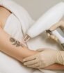 Close-up van een tattoo removal behandeling waarbij een huidtherapeut de huid zorgvuldig behandelt met een moderne lasertechniek
