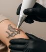 Close-up van laserbehandeling om een zwarte tattoo op de arm te verwijderen