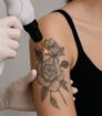 Close-up van een tattoo verwijderen kosten met moderne laser, gericht op het berekenen van realistische tattoo verwijderen kosten.