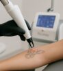Close-up van een Picoway laserbehandeling voor tatoeageverwijdering op de arm, met focus op precisie en huidveiligheid.