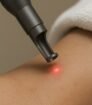 Close-up van een Picoway laser die de huid behandelt met precisie en minimale roodheid