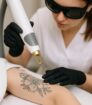Close-up van een laserbehandeling voor tattoo removal waarbij een tatoeage stap voor stap wordt verwijderd