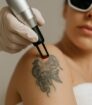Close-up van een tattoo verwijderen waarbij een tattoo op de bovenarm zorgvuldig wordt verwijderd