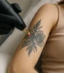 Close-up van een laserbehandeling om een bloemvormige tattoo op de arm te verwijderen.