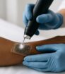 Laserhandstuk met koelpads op voorarm met donkerder huid; gecontroleerde puls bij tattoo verwijderen