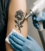 Laser verwijdert tatoeage op bovenarm in klinische setting