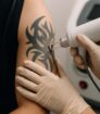 tattoo weglaseren kosten voor het verwijderen van een tattoo op de arm in een professionele kliniek.