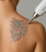 Picoway laser verwijdert multicolor tattoo op de schouder met precisie