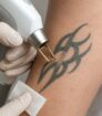 Close-up van een specialist die met een laserapparaat een tatoeage verwijdert van een onderarm.
