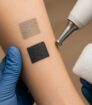 Voorarm met koelpad en laser; links vervaagde oude inkt, rechts donkere nieuwe inkt uitleg inktleeftijd.