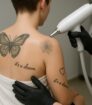 Specialist voert laserbehandeling uit om meerdere tattoos op de schouder te verwijderen — moderne techniek voor veilige en effectieve tattoo verwijdering.