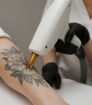Close up van een specialist die met een laserhandstuk een tatoeage op een onderarm behandelt.