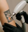 Laser verwijdert zwarte tatoeage op bovenarm tijdens professionele behandeling