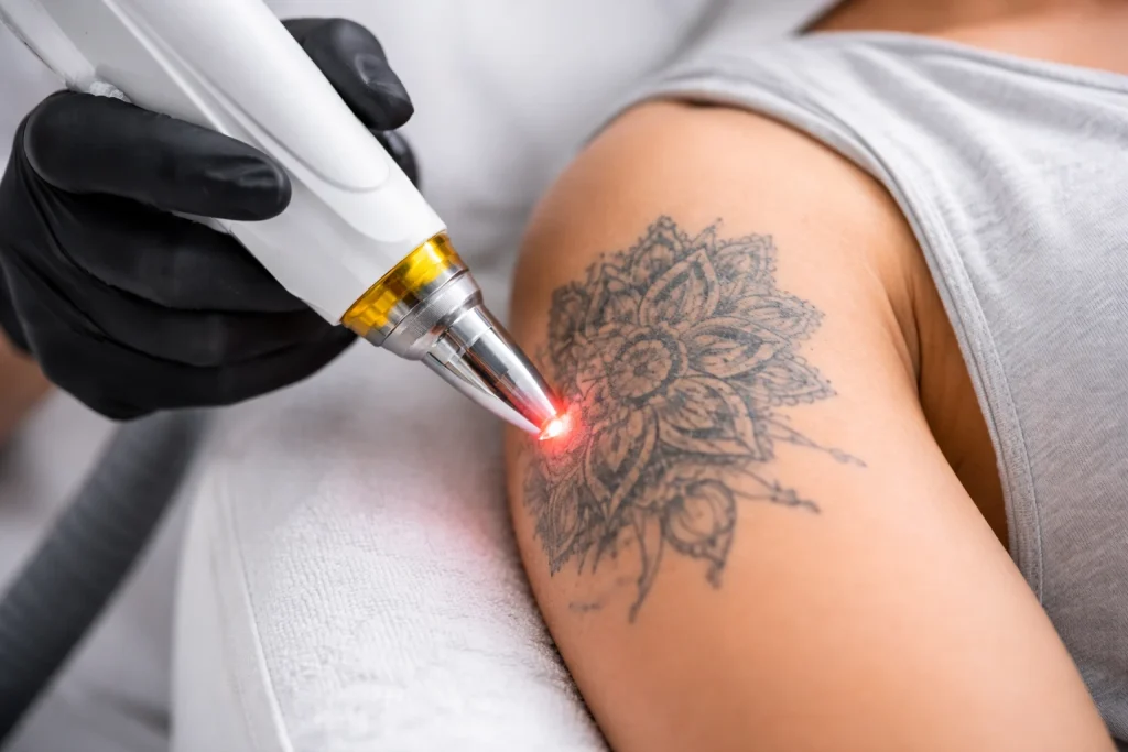 Tattoo weglaseren: Wat bepaalt of jouw tattoo volledig verdwijnt