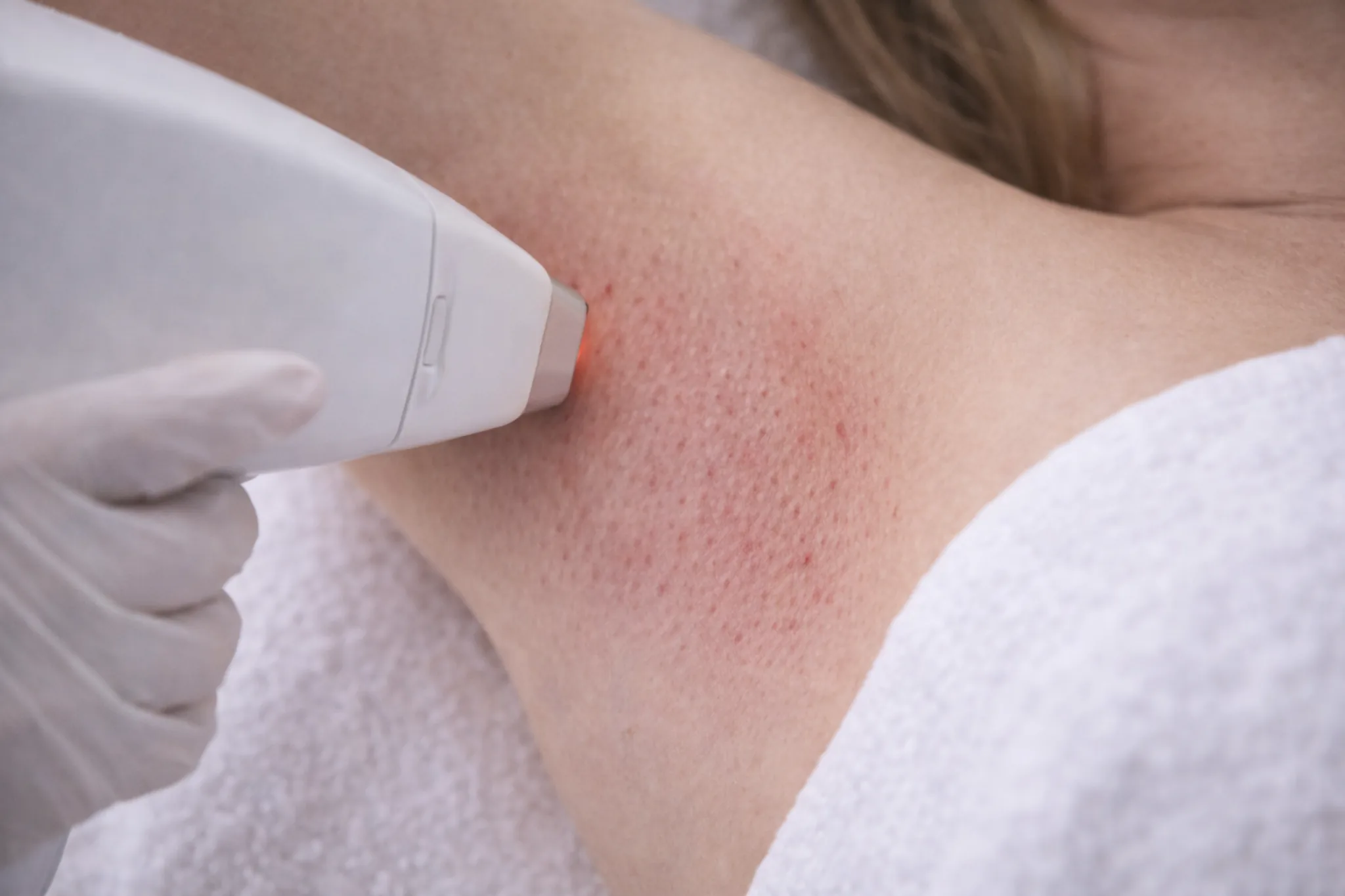 Close up van een oksel direct na laserontharing, met lichte roodheid rond de haarfollikels terwijl een behandelaar met handschoen een laserhandstuk op de huid plaatst.
