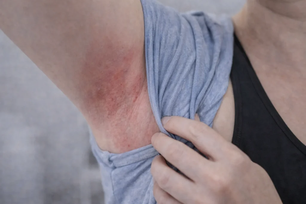 Oksels laseren Almere: Zo voorkomt u schuurplekken en irritatie door kleding