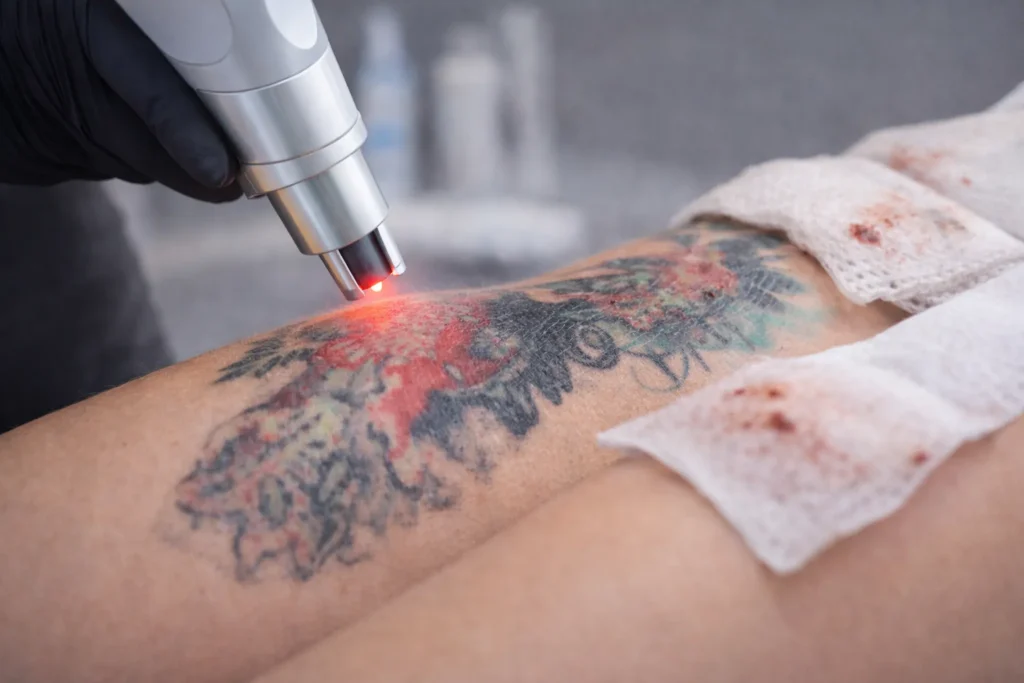 Koelen van behandelde huid na tattoo verwijderen met cold pack en gaas ter ondersteuning van nazorg