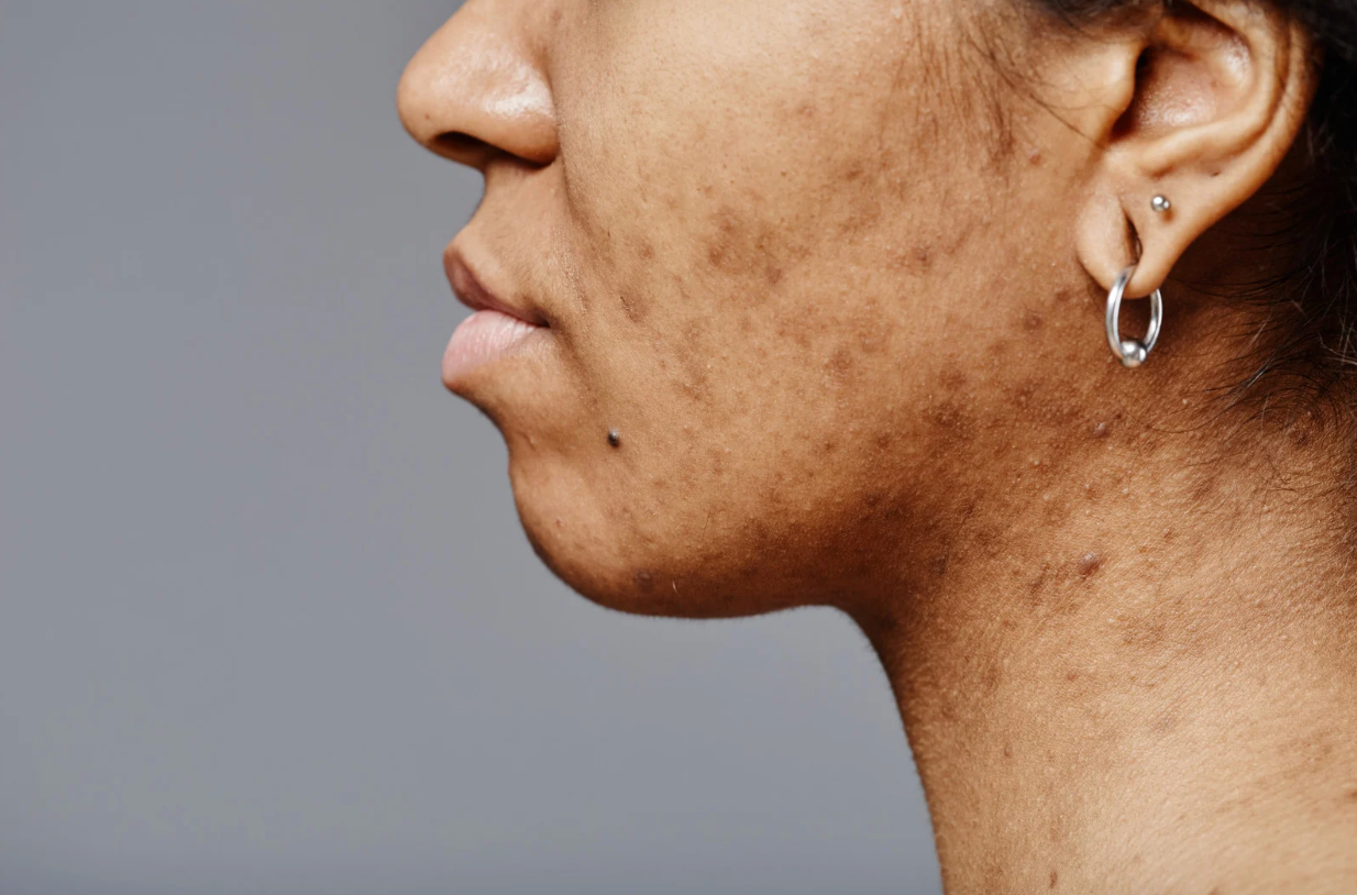 Acne laseren Almere, acnelittekens vervagen