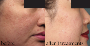Acne verwijderen