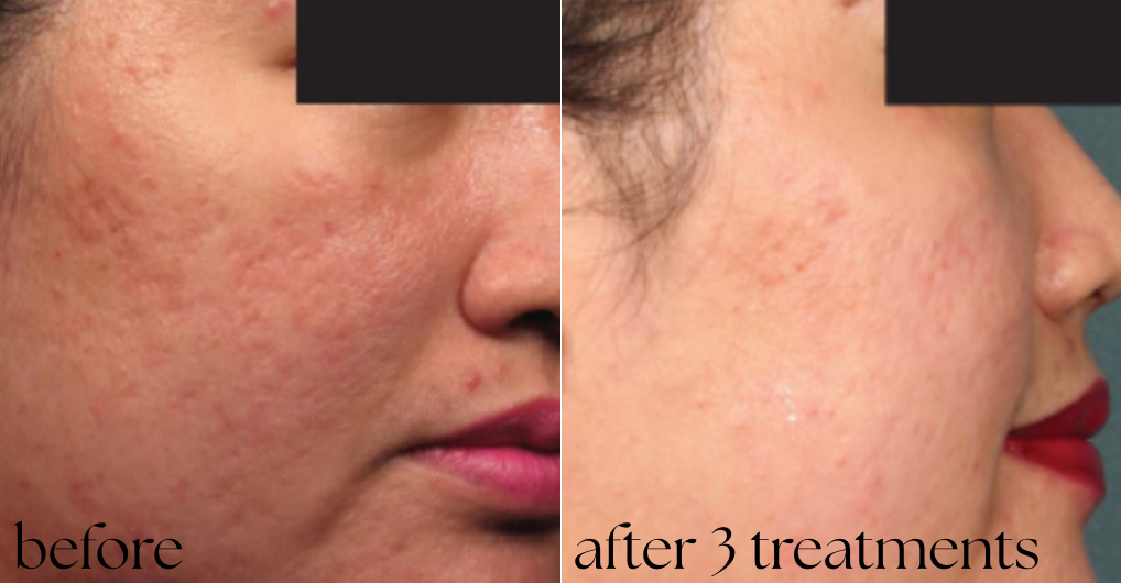 Acne verwijderen