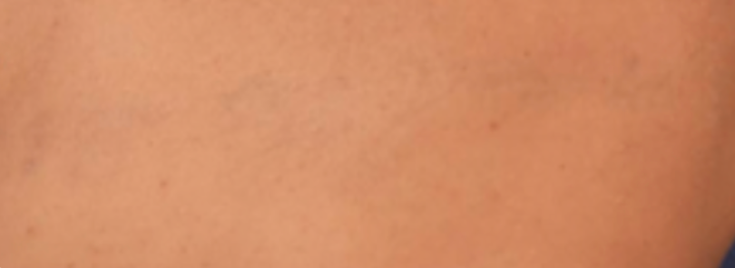 Na — Voor en na tattoo verwijderen Almere, PicoWay laser