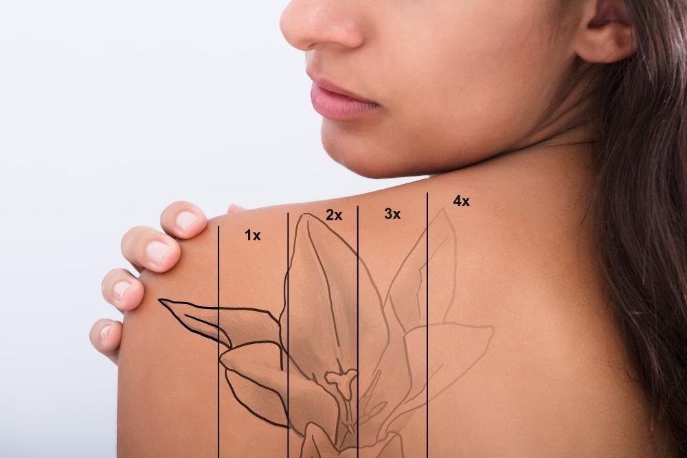 Tattoo verwijderen Almere — NDN.LASER