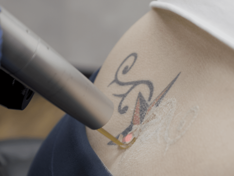 Tattoo verwijderen — NDN.LASER Almere